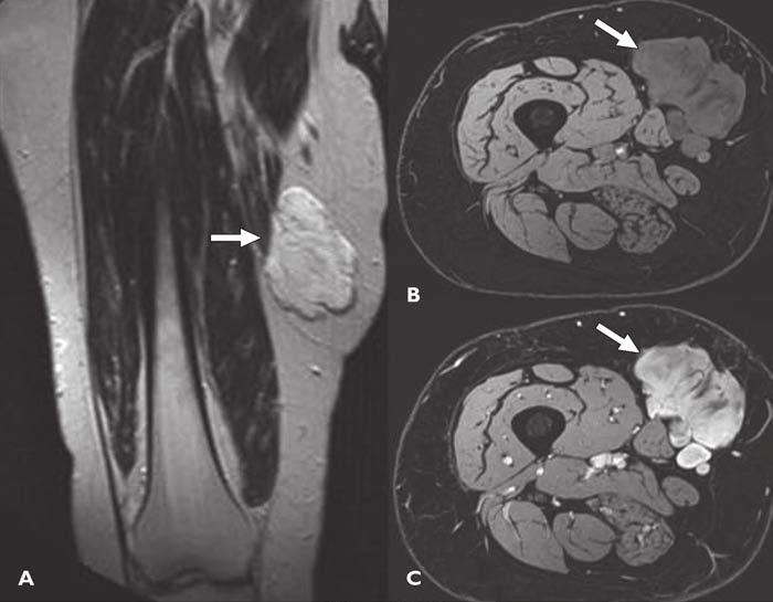 B and C, T1-weighted fat-saturated axial MR images before (B) and after (C) administration of gadolinium show intense enhancement of mass (arrows).