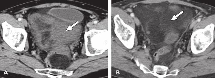 B, Axial T2-weighted MR image of thoracic spine shows multilobulated predominantly high-signal-intensity mass (arrow) involving right paraspinal muscles.