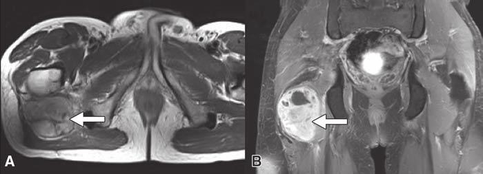 A and B, Axial T2-weighted (A) and coronal STIR T2-weighted (B) MR images of pelvis show heterogeneous but predominantly high-signal-intensity mass deep in relation to gluteal muscles (arrow).