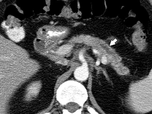MRI of the Pancreas bdominal Imaging Pictorial Essay Downloaded from www.ajronline.org by 37.44.192.155 on 12/14/17 from IP address 37.44.192.155. opyright RRS.