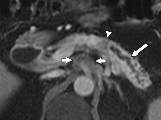 , xial T2-weighted HSTE MR image (5-mm slice thickness) shows pancreatic ductal dilation (arrow) with associated atrophy of pancreatic tail.