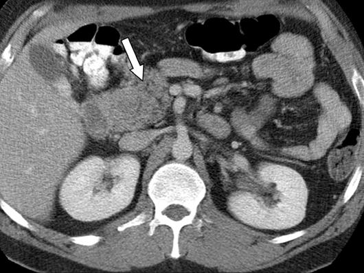 8-cm hypointense mass (arrowhead) in pancreatic body, consistent with pancreatic carcinoma. Pancreatic duct dilation (long arrow) and pancreatic atrophy upstream from mass are seen.