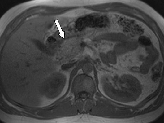 , xial contrast-enhanced MDT image shows prominent pancreatic head (arrow) suggesting possibility of subtle mass.