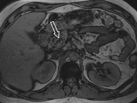 MRI of the Pancreas Downloaded from www.ajronline.org by 37.44.192.155 on 12/14/17 from IP address 37.44.192.155. opyright RRS. For personal use only; all rights reserved Fig.