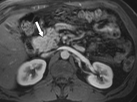 , xial T1-weighted opposed-phase gradient-recalled echo MR image shows signal dropout in pancreatic head (arrow) because of fatty infiltration without evidence of underlying mass.