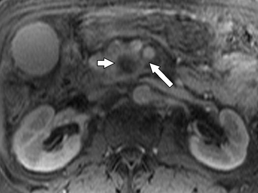 This double duct sign is highly suspicious for malignancy., xial late arterial-phase gadolinium-enhanced T1-weighted fat-suppressed gradient-recalled echo MR image shows 2.