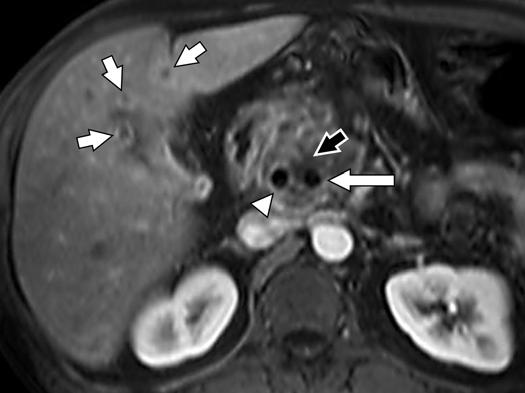 Important secondary signs may be present to suggest that an underlying pancreatic mass exists.
