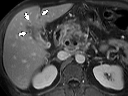 Prominent Pancreatic Head on T prominent pancreatic head may be seen on contrast-enhanced T and may be difficult to distinguish from a mass.