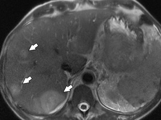 MRI of the Pancreas Downloaded from www.ajronline.org by 37.44.192.155 on 12/14/17 from IP address 37.44.192.155. opyright RRS.