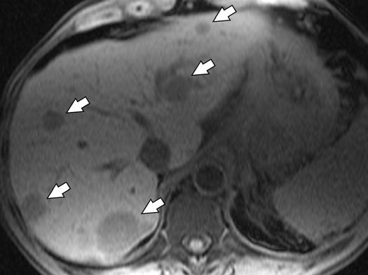 , xial T2-weighted HSTE MR image shows multiple, moderately hyperintense liver lesions (arrows) caused by metastases.