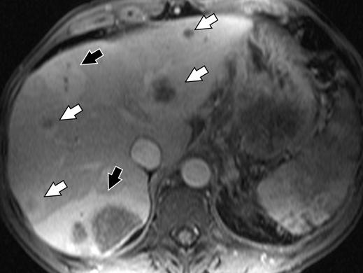 , xial arterial-phase gadolinium-enhanced T1-weighted fat-suppressed gradientrecalled echo MR image shows ring-enhancing lesions (white arrows) and