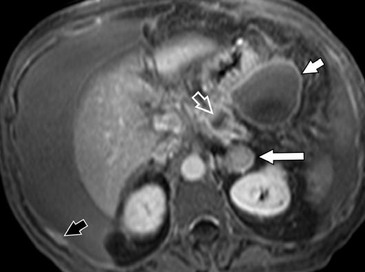 6 57-year-old woman with newly diagnosed pancreatic carcinoma and peritoneal metastases.