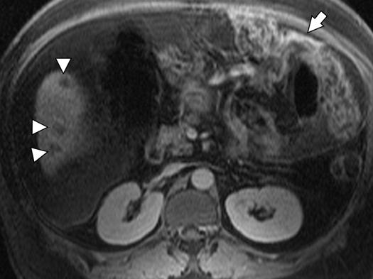, xial unenhanced T1-weighted fat-suppressed gradient-recalled echo MR image shows low-signal-intensity lesions (arrows) in liver, consistent with metastases.