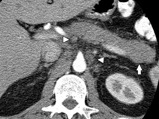 Hypointense liver metastases (arrowheads) are also identified. Fig.