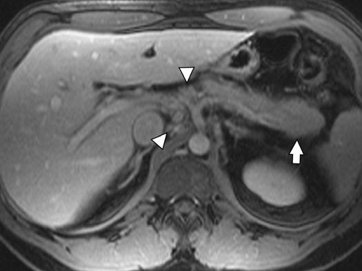 MRI of the Pancreas Fig. 8 (continued) 36-year-old man with clinical history of pancreatitis was subsequently proven to have pancreatic carcinoma with axillary lymph node metastases.