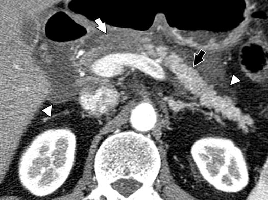 MDT. Multiple retroperitoneal lymph nodes (arrowheads) are also identified around celiac artery. Downloaded from www.ajronline.org by 37.44.192.155 on 12/14/17 from IP address 37.44.192.155. opyright RRS.