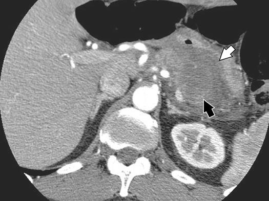 [5] described liver metastases as minimally hypointense on T1-weighted images and isointense to moderately hyperintense on T2-weighted images.