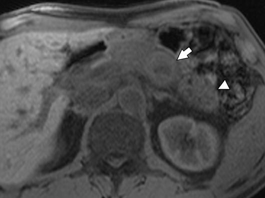 [7] found MRI to be superior to T in detection of upper abdominal peritoneal metastases and implants smaller than 1 cm, which are best seen in the presence of ascites (Figs. 6 and 7). E Fig.