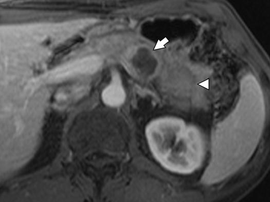 , xial T2-weighted HSTE MR image performed 3 weeks after MDT () shows pancreatic duct dilation and atrophy of pancreatic tail (arrow).