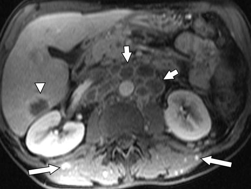 , xial T2-weighted HSTE MR image shows multiple periaortic lymph nodes (white arrows) and hyperintense metastasis (black arrow) in