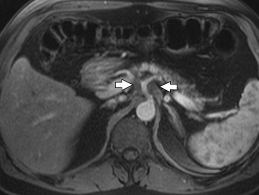 , xial gadolinium-enhanced T1-weighted fat-suppressed gradient-recalled echo MR image shows multiple, ring-enhancing, periaortic