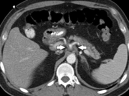 , xial gadolinium-enhanced T1-weighted fat-suppressed gradient-recalled echo MR image shows abnormal enhancing soft tissue (arrows)