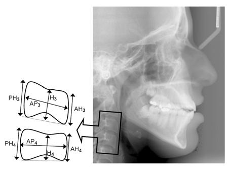 J. King Saud Univ., Vol. 22, Dental Sci. (1), Riyadh (2010/1431H.) 3 Fig. 3. Profilogram of the cephalometric landmarks and measurements for the young and adult female groups.
