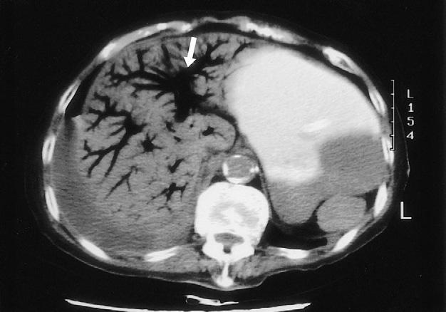 Comuted tomograhy findings: annular intramural air (intramural neumatosis) is demonstrated over multile smallbowel