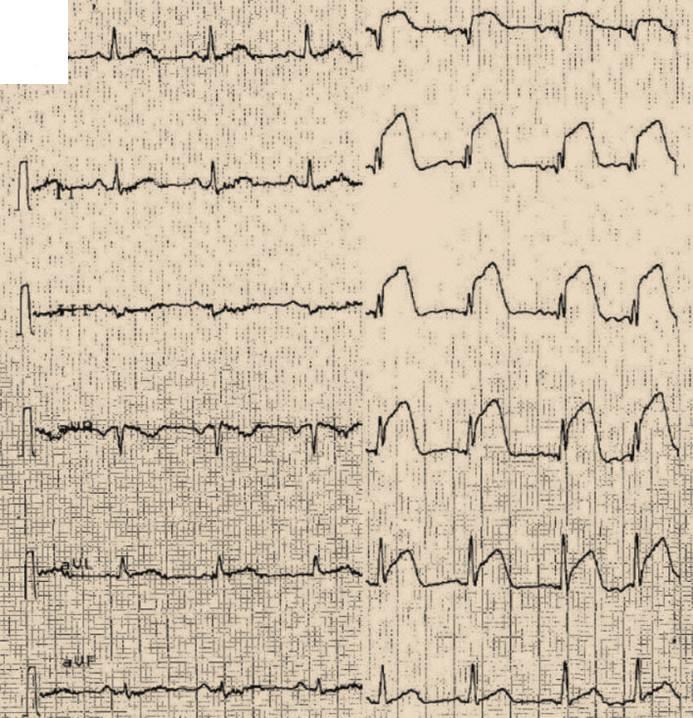 2 Case Reports in Cardiology (c) (c) (d) (d) Figure 1 performed during the following two days without significantly reducing the heart rate at target (90 bpm with 12.5 mg carvedilol b.i.d.). Ivabradine was then administered at 5 mg b.