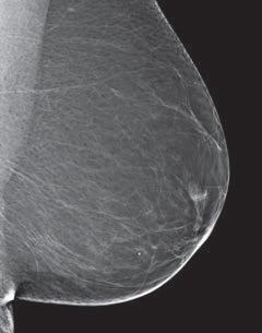 classify breast density into 4 categories.