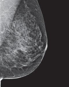 More of the breast is made of dense glandular and fibrous tissue (described as
