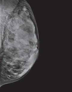Breasts are extremely dense, which makes it hard to see tumors in the tissue. Some mammogram reports sent to women mention breast density.