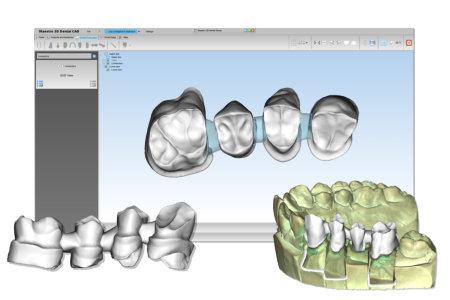 Bracket Placement Indirect bonding is now a simplified task with post treatment