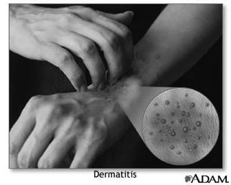 Dermatitisinflammation of the skin caused by various reasons: soap,