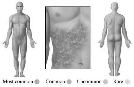 (has nothing to do with worms) Hives (urticaria)