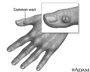 Warts- (Human Papilloma Virus- HPV) Common warts tend to cause no discomfort unless they are in areas of