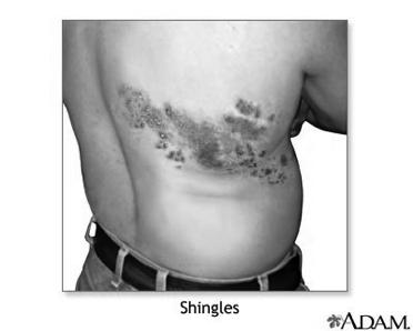 77 Shingles (herpes zoster)- viral infection of nerve endings.