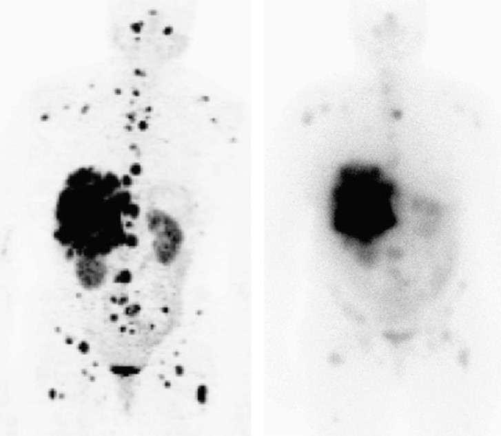 Anterior 3D Maximum Intensity Projection image of a 68 Ga DOTATOC PET scan (left) compared to an 111 In- Octreotide