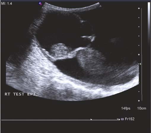 Figure 1. Realtime sonography demonstrates a well-demarginated cystic septated lesion arising from the upper pole of the right testicle. The lesion measures 6.5 cm 5.6 cm 6.3 cm and contains a 1.