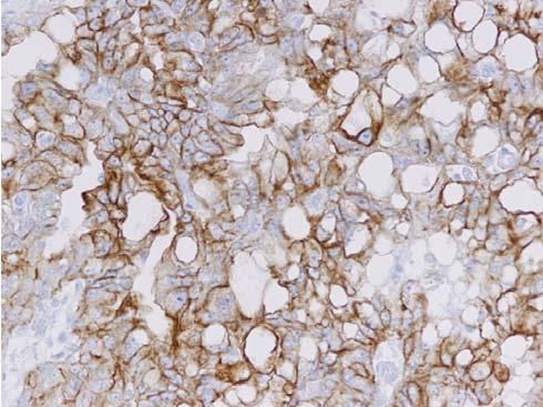 immunohistochemical findings, and past medical history, the diagnosis was