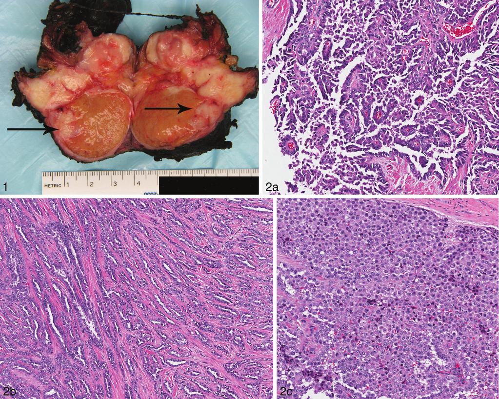 Figure 1. Gross photograph showing thickened tunica vaginalis with the arrows indicating yellow-white solid tumor extending into the testicular parenchyma and paratesticular structures. Figure 2.