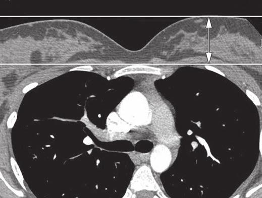 Breast Dose Reduction in Thoracic CT TABLE 1: Breast Dose Reduction for All Breast Thicknesses Fig. 2 23-yearold woman with pulmonary embolism suspicion, referred for CT angiography.