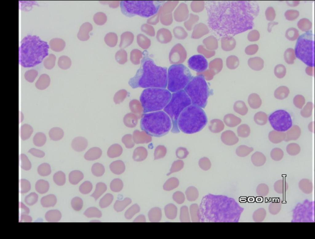 23-year-old male with lymphadenopathy