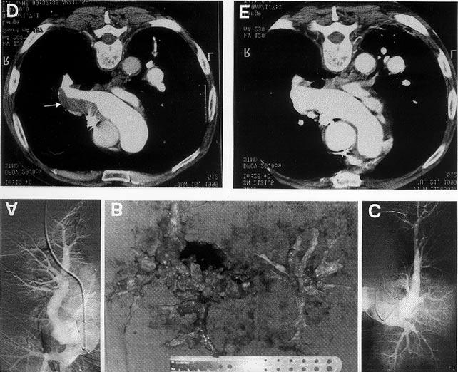 Surgery for chronic thromboembolic disease Figure 2) Radiological and pathological findings in a patient with chronic thromboembolic pulmonary hypertension. A Preoperative right pulmonary angiogram.