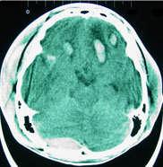 Traumatic Brain Injury Also known as intracranial injury or simply head injury Occurs when physical trauma causes