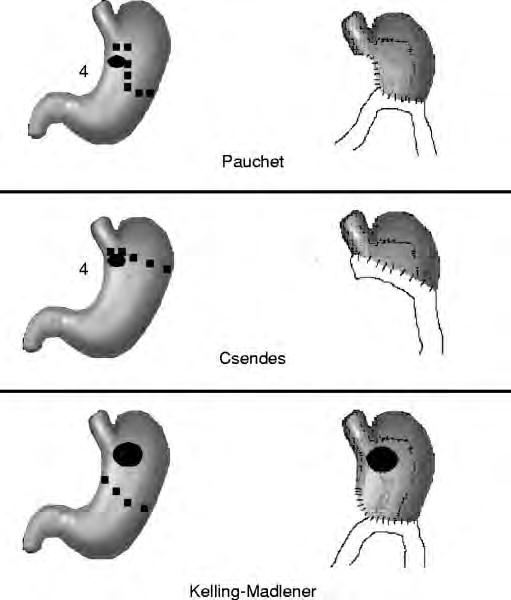 Procedure for type 4 gastric ulcer Pauchet procedure for ulcer > 2 cm