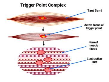 Trigger Point Management What is a Trigger Point (TrP)? Ø A trigger point is a hyperirritable spot located in a taut band of skeletal muscle.