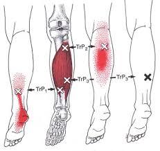 o Calf cramps, typically at night o Pain on at the back of the knee or inner region of the foot o Pain with