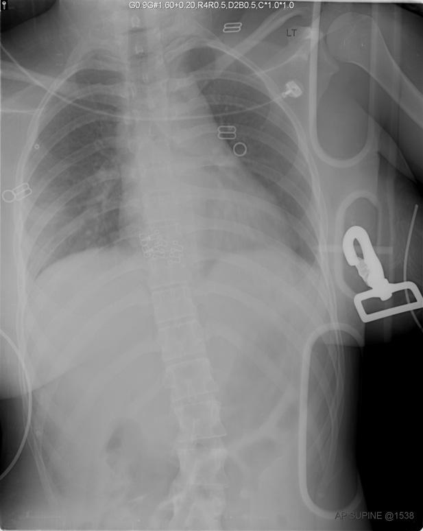 Chest Radiograph Patient MG Portable AP view No identifiable pneumothorax or rib fractures Widened upper mediastinum Indistinct