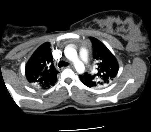 CT Patient MG High density material in mediastinum consistent with